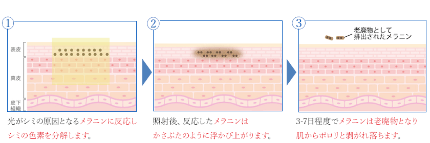 ①光がシミの原因となるメラニンに反応しシミの色素を分解します。 ②照射後、反応したメラニンはかさぶたのように浮かび上がります。 ③3-7日程度でメラニンは老廃物となり肌からポロリと剥がれ落ちます。