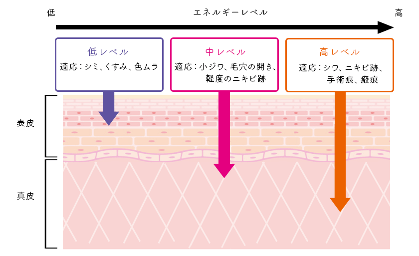 【低レベル】適応：シミ、くすみ、色ムラ 【中レベル】適応:小ジワ、毛穴の開き、軽度のニキビ跡 【高レベル】適応:シワ、ニキビ跡、手術痕、瘢痕