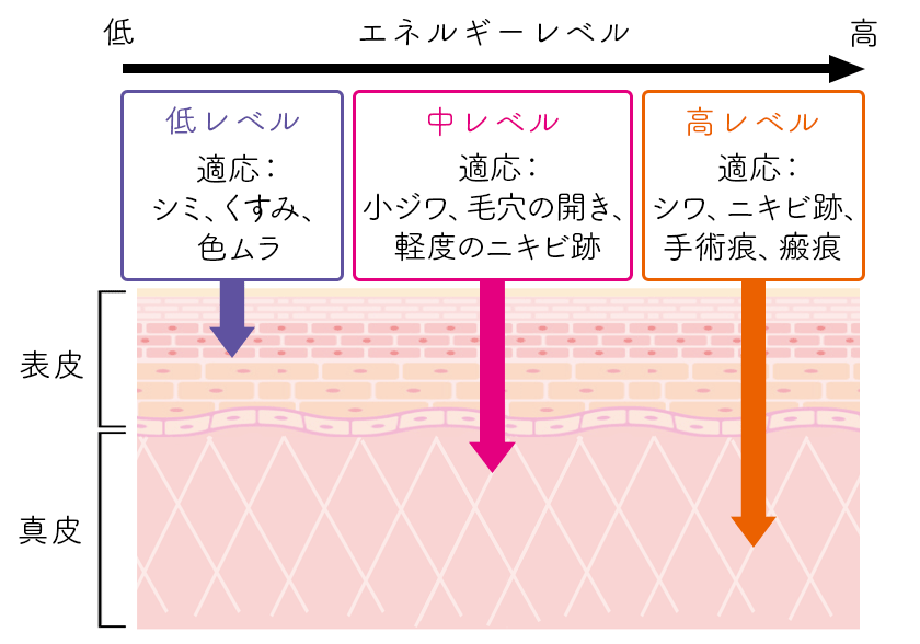 【低レベル】適応：シミ、くすみ、色ムラ 【中レベル】適応:小ジワ、毛穴の開き、軽度のニキビ跡 【高レベル】適応:シワ、ニキビ跡、手術痕、瘢痕