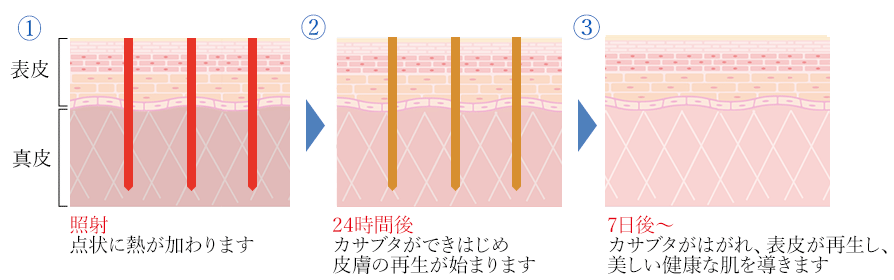 1.照射 点状に熱が加わります→2.24時間後 カサブタができはじめ皮膚の再生が始まります→3.7日後～ カサブタがはがれ、表皮が再生し、美しい健康な肌を導きます