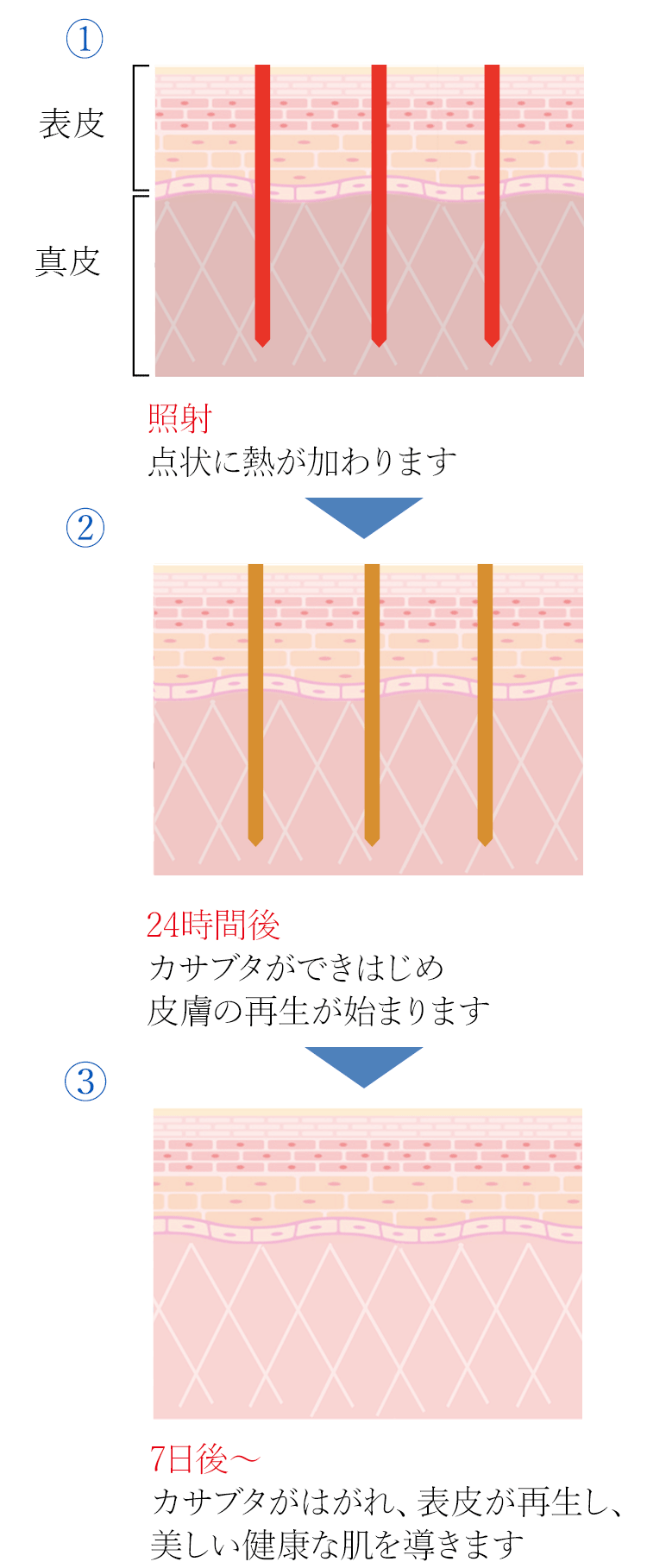 1.照射 点状に熱が加わります→2.24時間後 カサブタができはじめ皮膚の再生が始まります→3.7日後～ カサブタがはがれ、表皮が再生し、美しい健康な肌を導きます