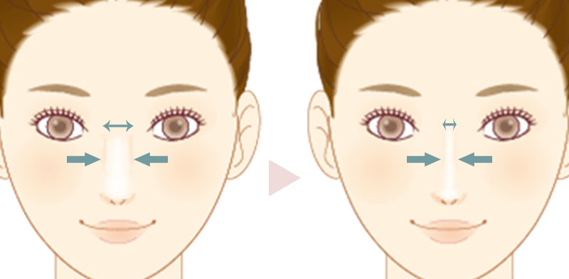 鼻骨骨切り_before_after