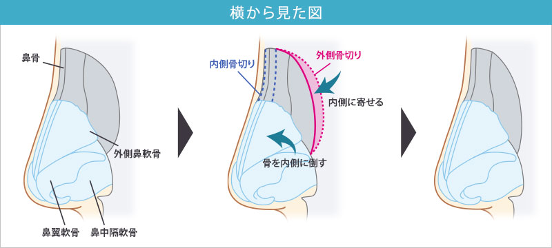 鼻骨骨切り_横から見た図