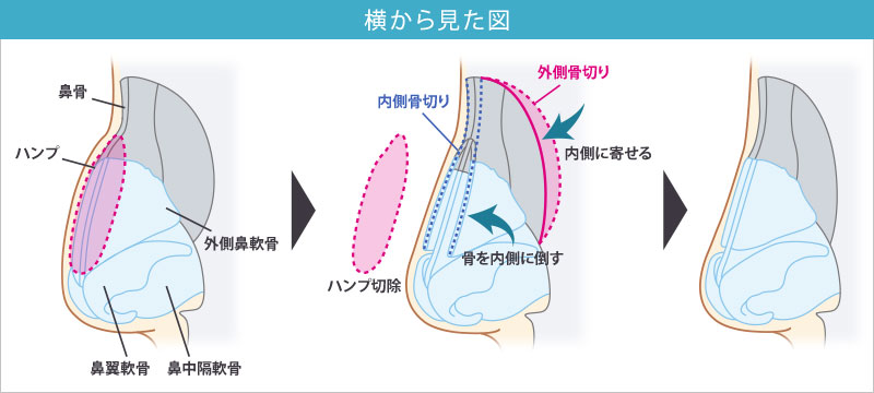 鼻骨骨切り＋ハンプ切除_横から見た図