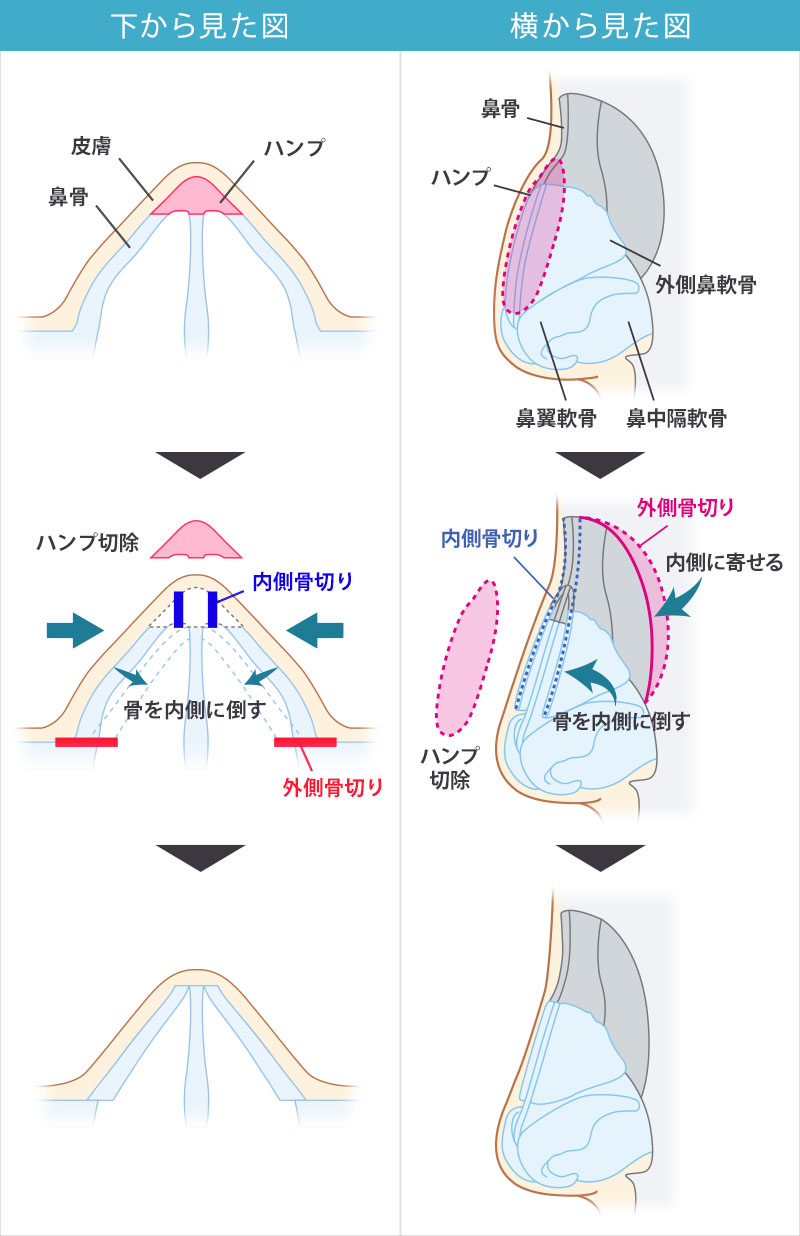 鼻骨骨切り+ハンプ切除