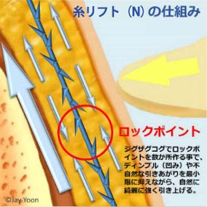 ロックポイント：ジグザグコグでロックポイントを数か所作る事で、ディンプル（凹み）や不自然な引きあがりを最小限に抑えながら、自然に綺麗に強く引き上げる