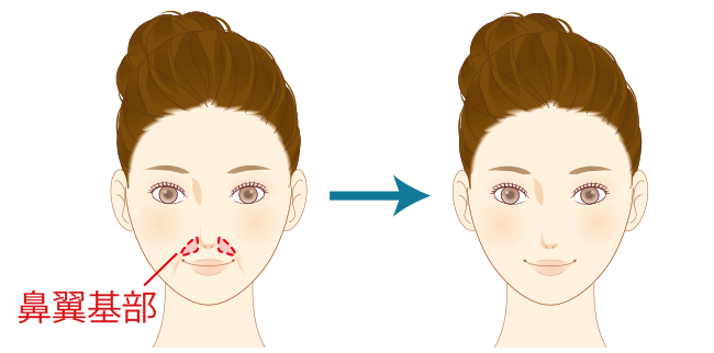 貴族注射とは_鼻翼基部