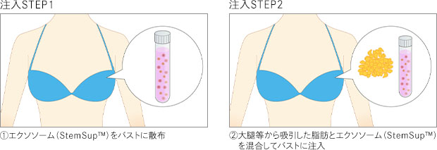 注入STEP1 ①エクソソーム (StemSup™) をバストに散布 注入STEP2 ②大腿等から吸引した脂肪とエクソソーム (StemSup™) を混合してバストに注入