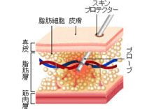 脂肪を吸引