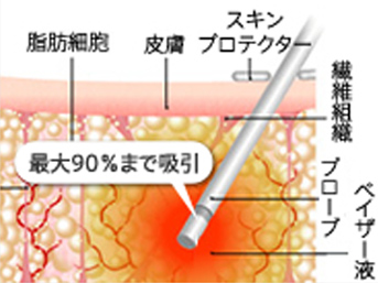 スキンプロテクター