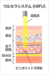 ウルセラシステム（HIFU） ピンポイントで照射