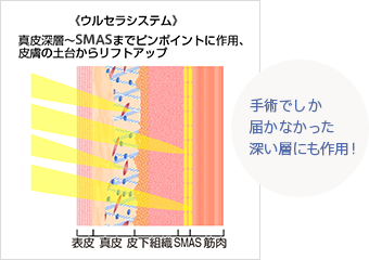 ＜ウルセラシステム＞ 真皮深層～SMASまでピンポイントに作用、皮膚の土台からリフトアップ 手術でしか届かなかった深い層にも作用！