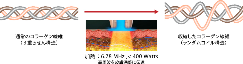 DENSITYのメカニズム