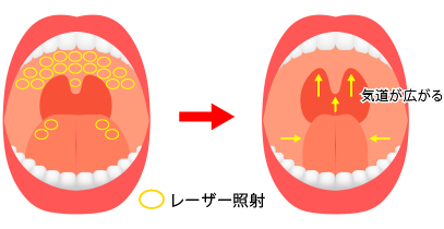 レーザーによるいびき治療