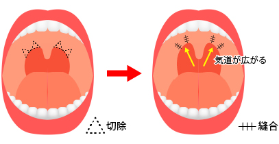 切除をするいびき治療