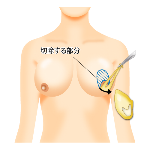 切開、縫合部分