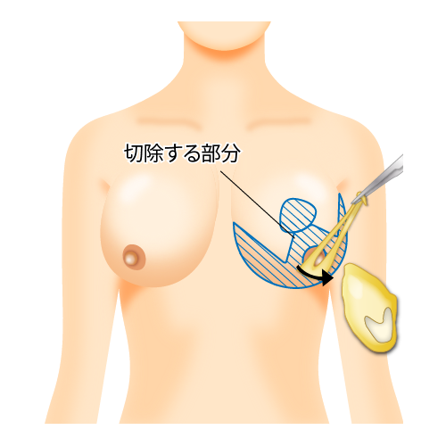 施術方法2
 除去部分
