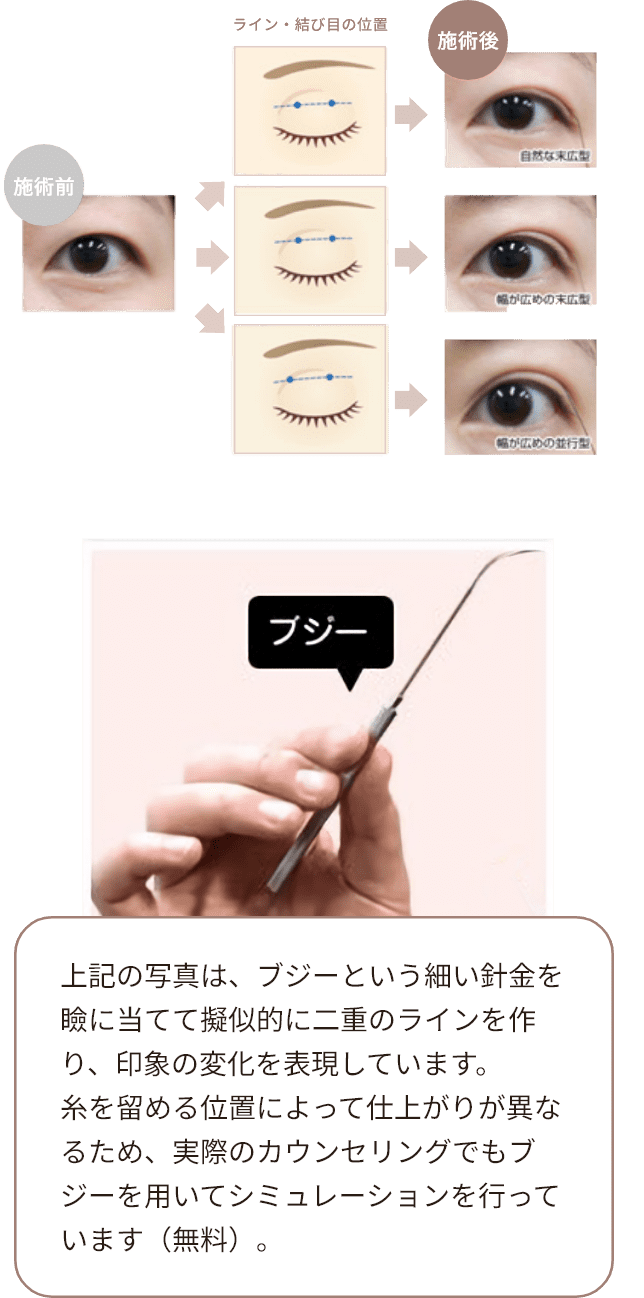 ブジーという細い針金を瞼に当てて擬似的に二重のラインを作り、印象の変化を表現しています。糸を留める位置によって仕上がりが異なるため、実際のカウンセリングでもブジーを用いてシミュレーションを行っています（無料）。