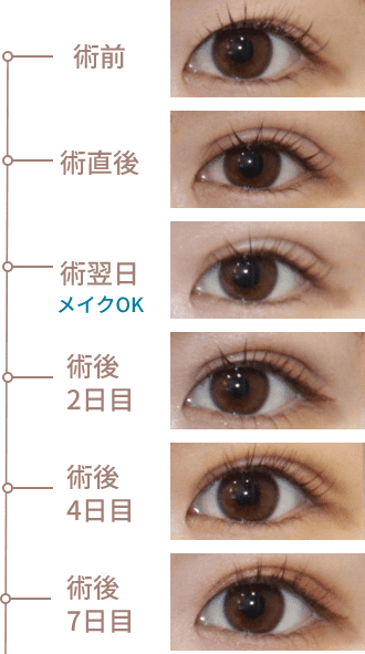術前から術後7日目までの経過写真。術翌日にはメイクOK