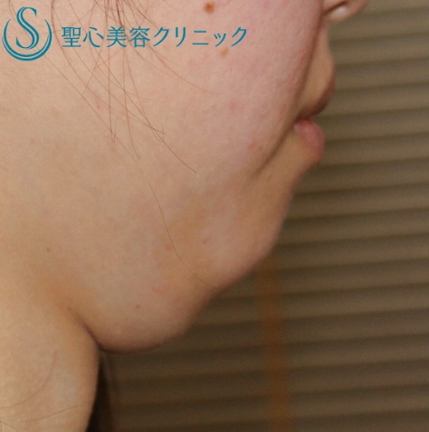 Fatx症例before