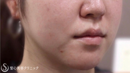 Fatx症例before