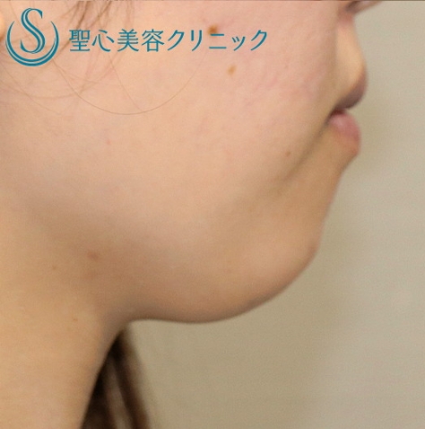 Fatx症例after