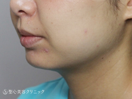 チンセラ症例before