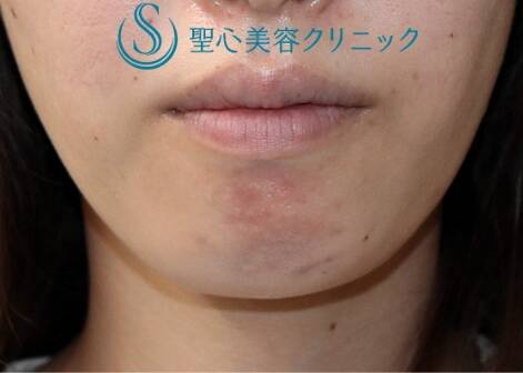 after