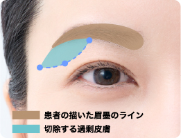 患者様の理想の眉ラインに合わせマーキング