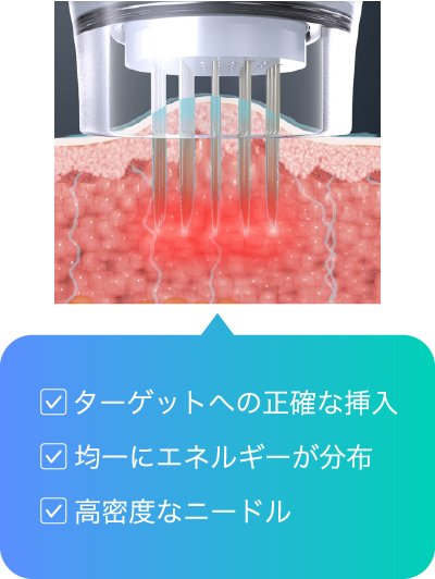ターゲットへの正確な挿入 均一にエネルギーが分布 高密度なニードル