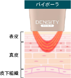 バイポーラRF
