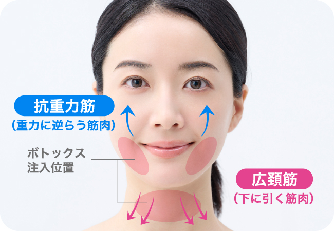 ボトックスリフト
