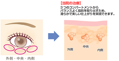 【一般的な治療】 中央部の脂肪のみ取り出した場合、そこだけ皮膚が凹み、しわが目立ってしまう場合があります。 【当院の治療】 3つのコンパートメントからバランスよく脂肪を取り出すため、滑らかで美しい仕上がりを実現できます。