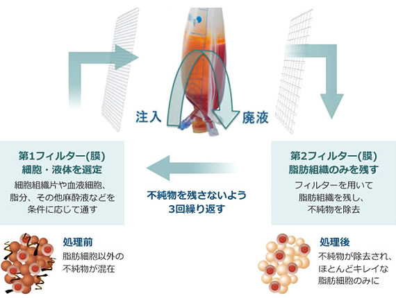 高性能細胞精製器”ピュアグラフト”で不純物80%除去