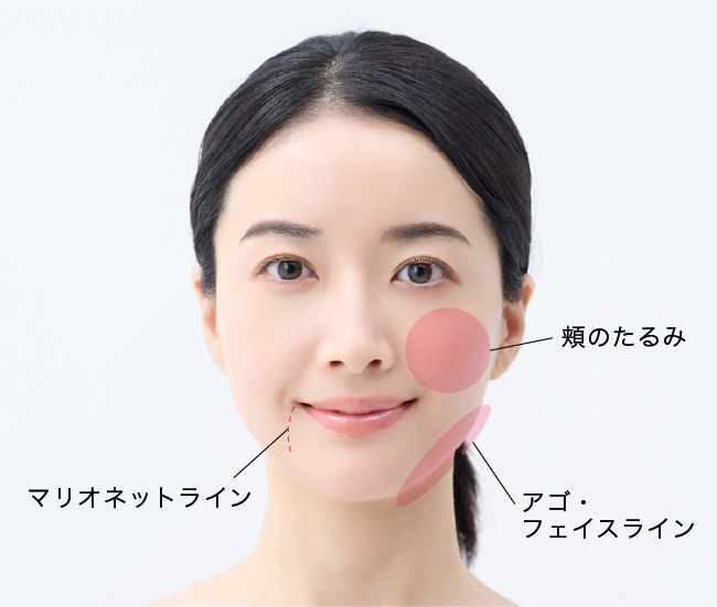 マリオネットライン・頬のたるみ・アゴ・フェイスライン