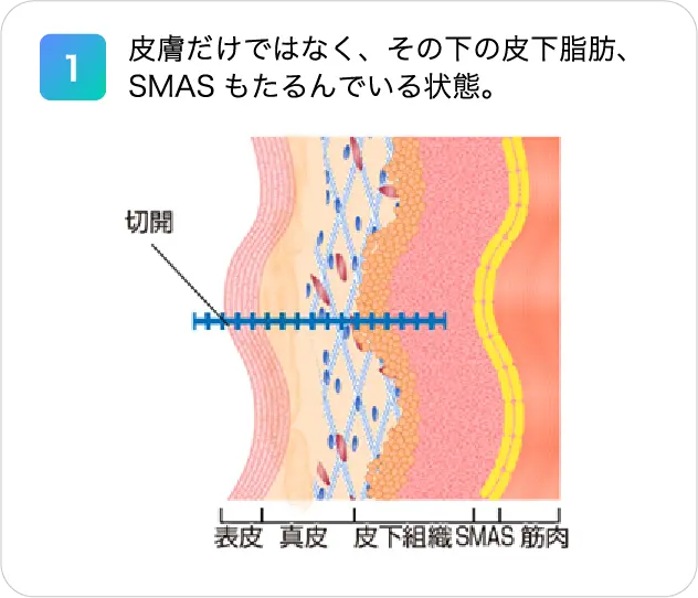 1.皮膚だけではなく、その下の皮下脂肪、SMASもたるんでいる状態。