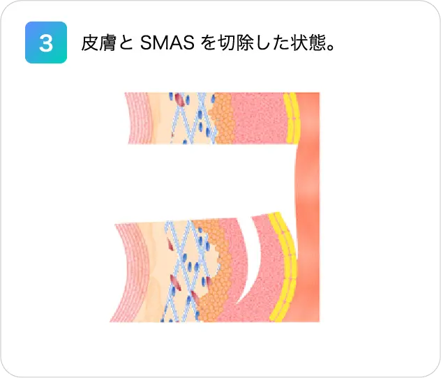 3.皮膚とSMASを切除した状態。