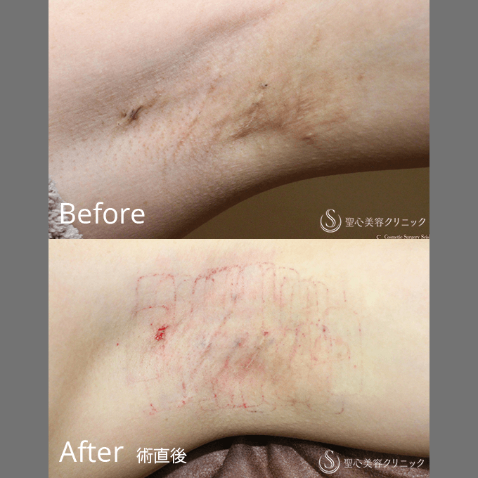 前多一彦　聖心美容クリニック　札幌院院長/ミラドライ（処置直後）